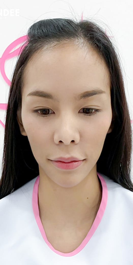 𝗙𝗜𝗟𝗟𝗘𝗥 หน้าเด็ก เติมเต็มแก้มส้ม + แก้มตอบ