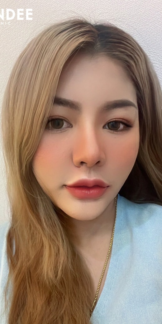 แฟตลดไขมัน ตัวช่วยหน้าเรียว