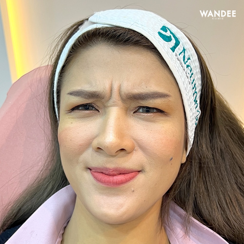 𝐁𝐎𝐓𝐎𝐗 ลดริ้วรอย