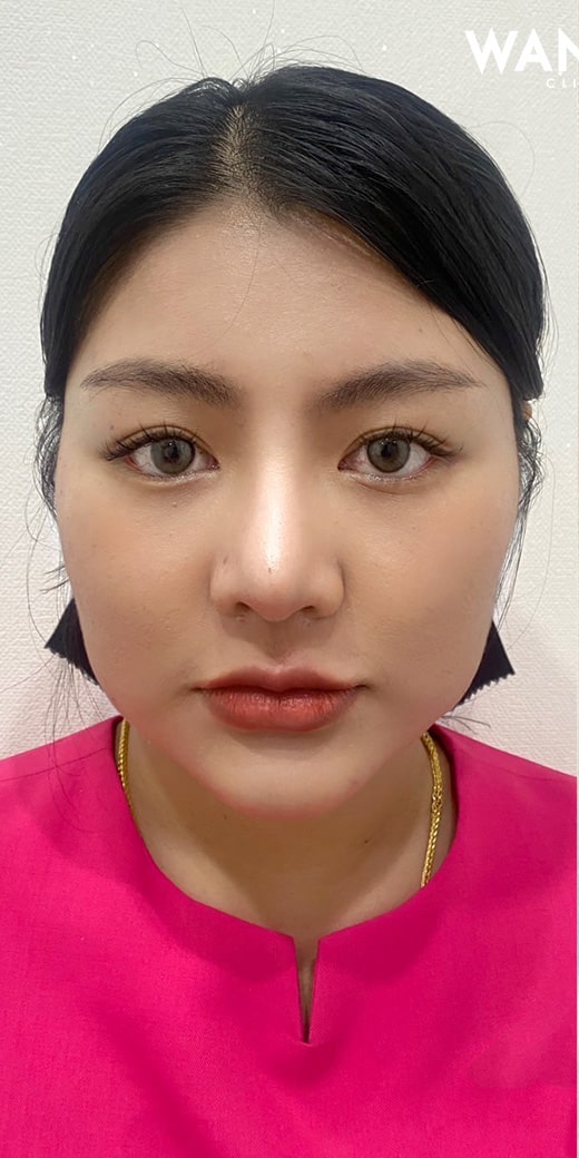 แฟตลดไขมัน ตัวช่วยหน้าเรียว