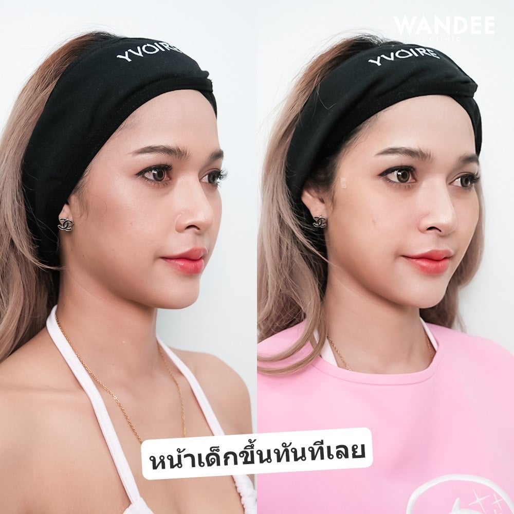 𝗙𝗜𝗟𝗟𝗘𝗥 แก้มส้ม