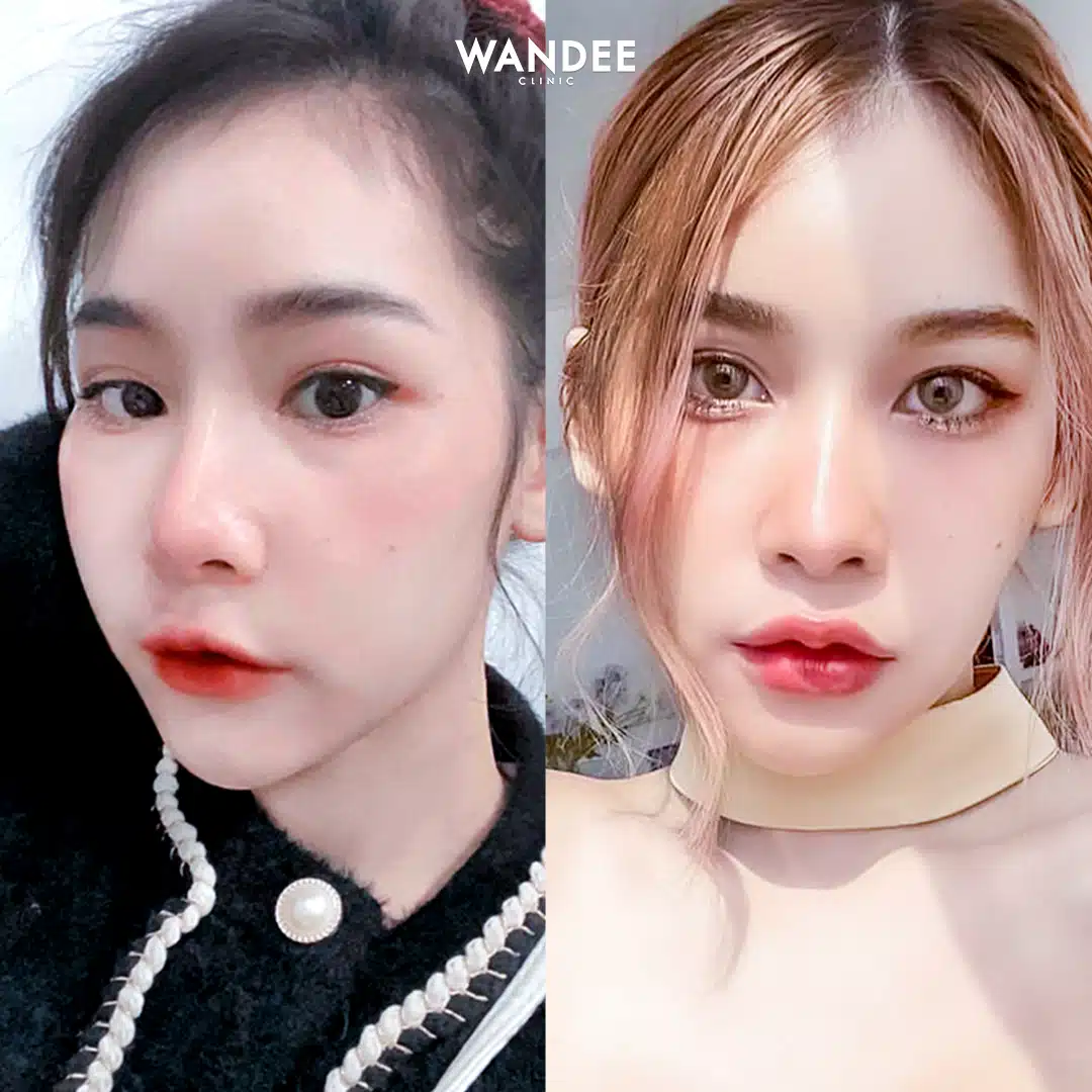𝗕𝗢𝗧𝗢𝗫 VS 𝗙𝗜𝗟𝗟𝗘𝗥