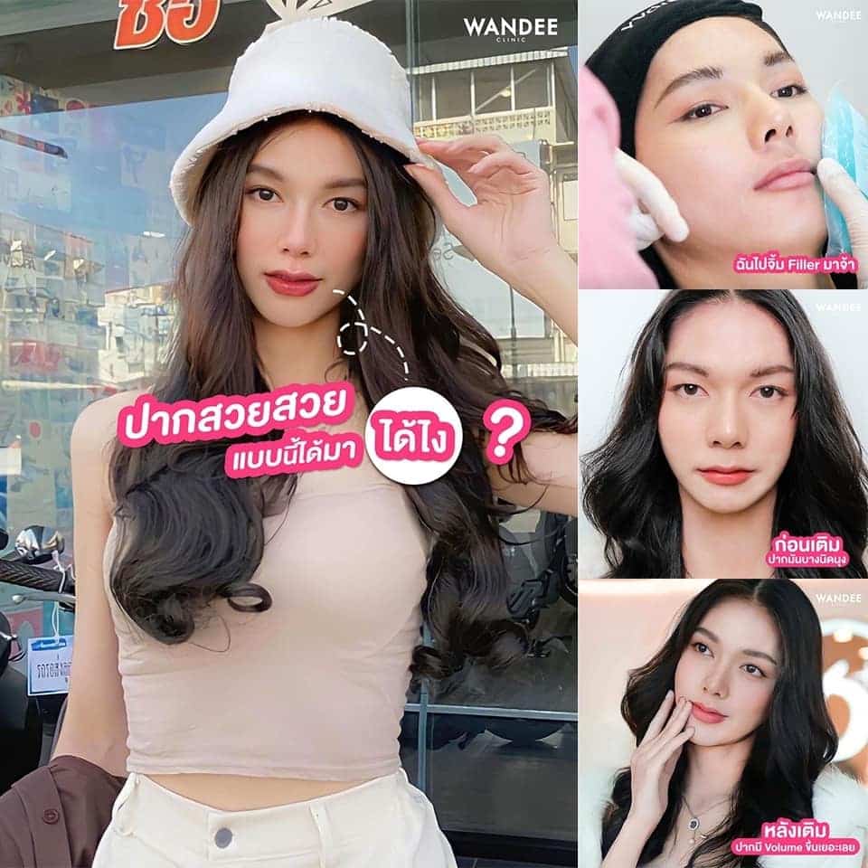 เติมฟิลเลอร์ปาก