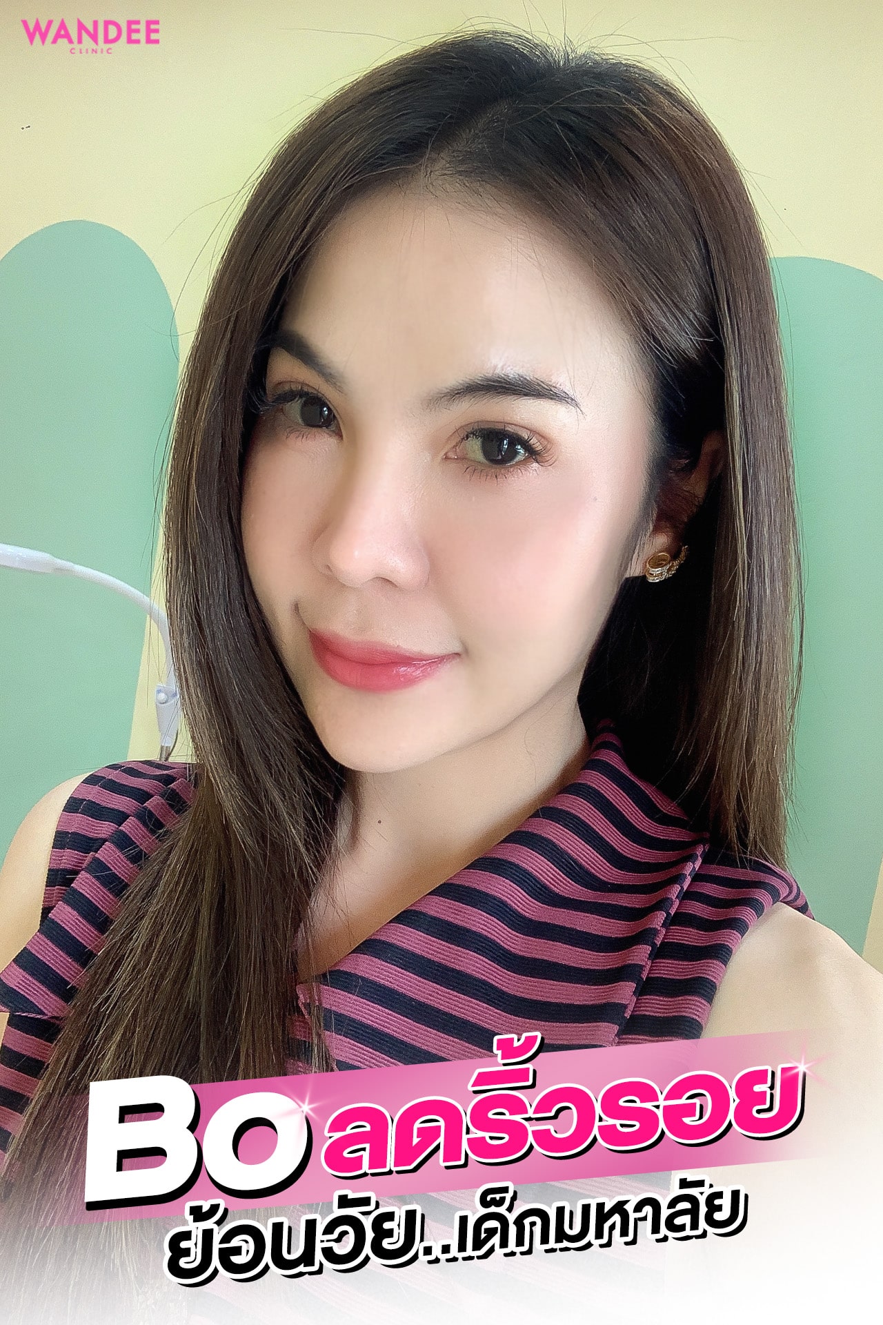 𝗕𝗢𝗧𝗢𝗫 ลดริ้วรอย