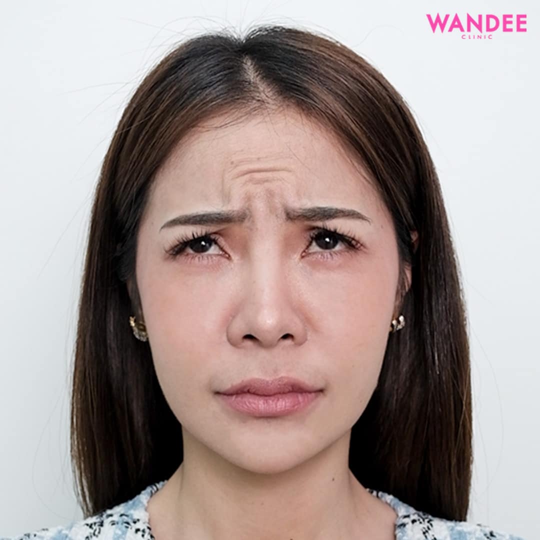 𝗕𝗢𝗧𝗢𝗫 ลดริ้วรอย