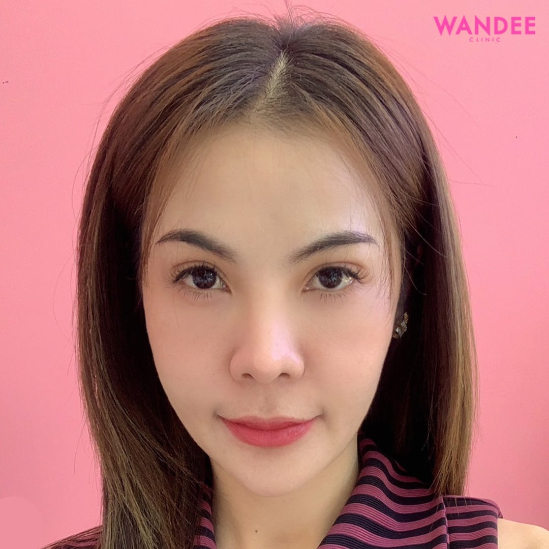 𝗕𝗢𝗧𝗢𝗫 ลดริ้วรอย