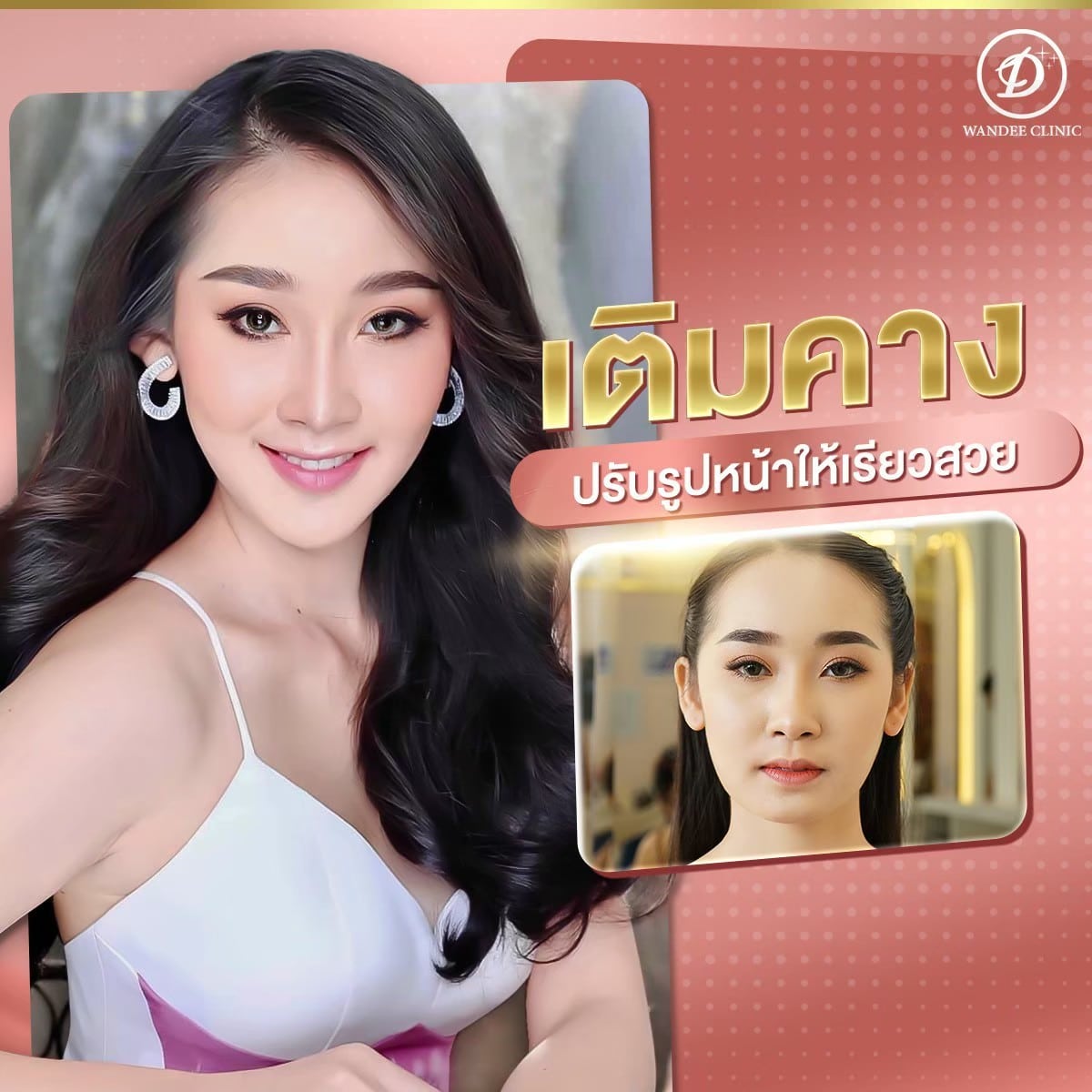 เติม 𝗙𝗜𝗟𝗟𝗘𝗥 คาง