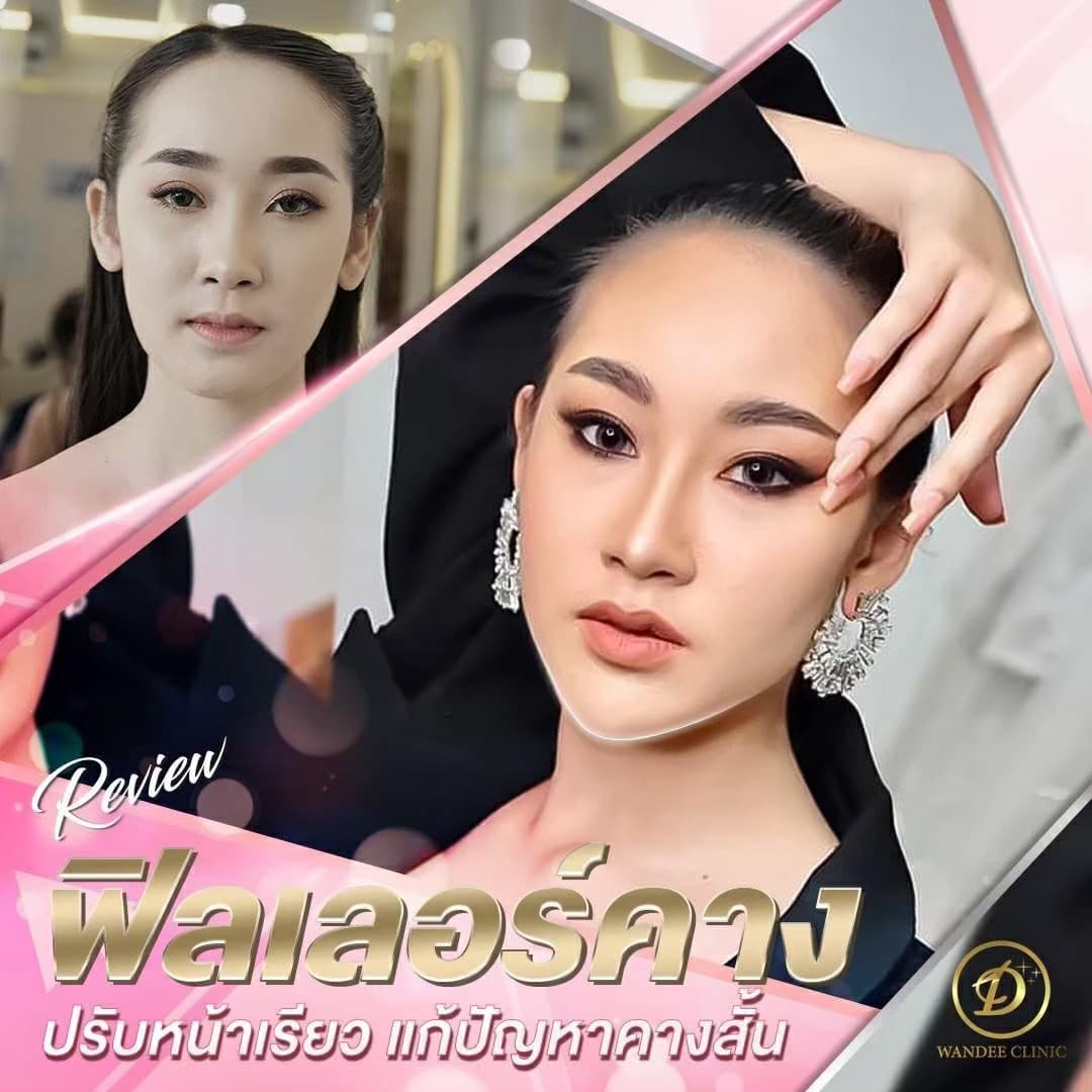 เติม 𝗙𝗜𝗟𝗟𝗘𝗥 คาง