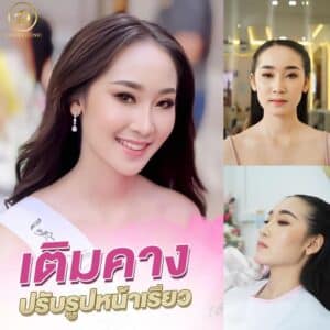 เติม 𝗙𝗜𝗟𝗟𝗘𝗥 คาง