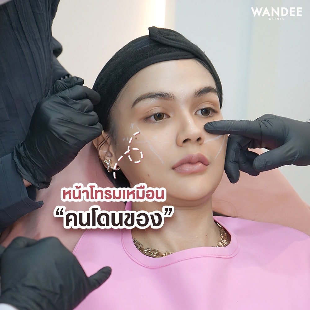 รีวิวความประทับใจฟิลเลอร์ใต้ตา