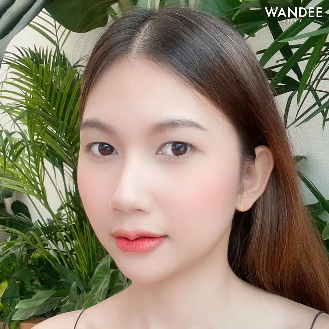 เติม 𝗙𝗜𝗟𝗟𝗘𝗥 ปาก