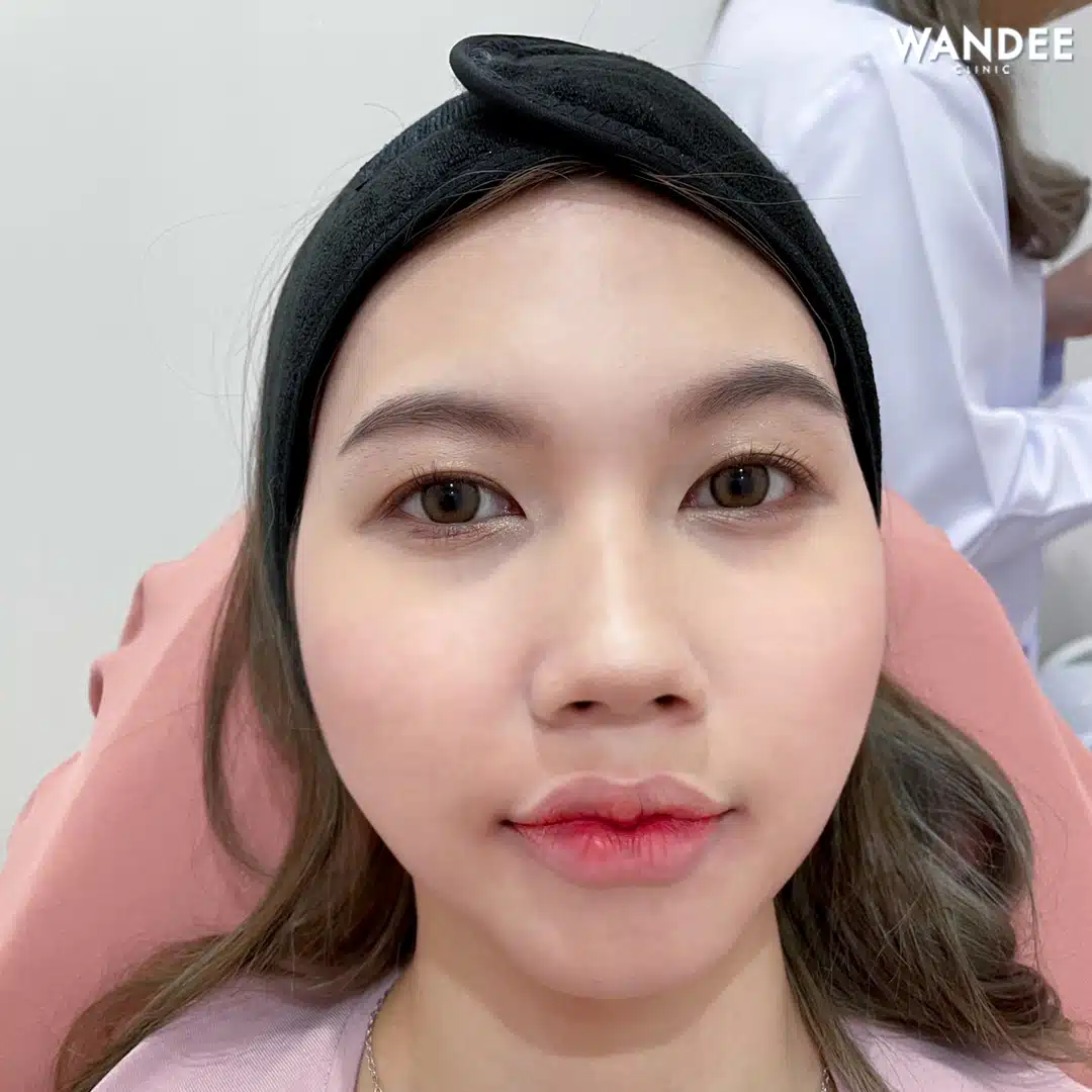 เติม 𝗙𝗜𝗟𝗟𝗘𝗥 ปาก