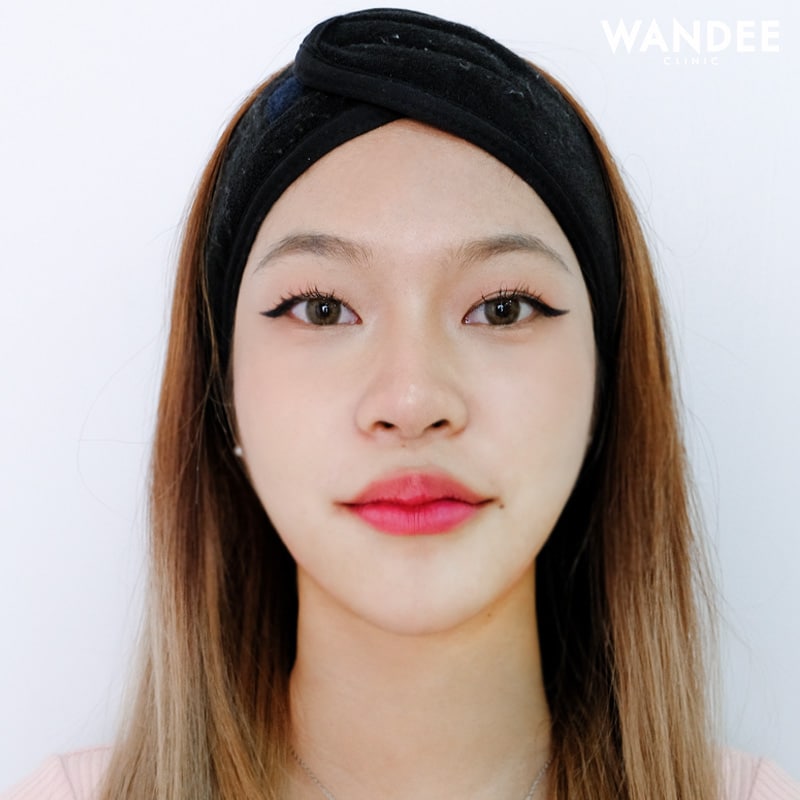 เติมคาง V-shape