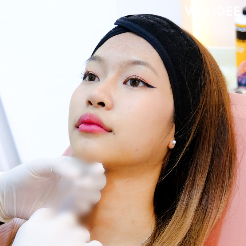 เติมคาง V-shape