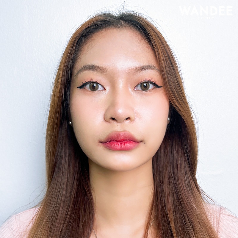 เติมคาง V-shape