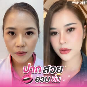 ปากสวยอวบอิ่ม แค่เติมปาก