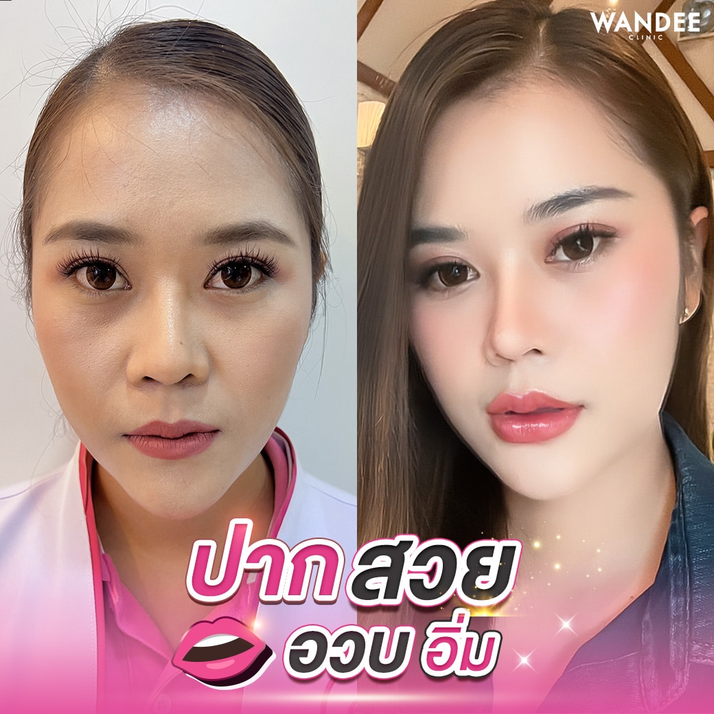 ปากสวยอวบอิ่ม แค่เติมปาก