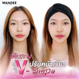 เติมคาง หน้าเรียวเป๊ะ