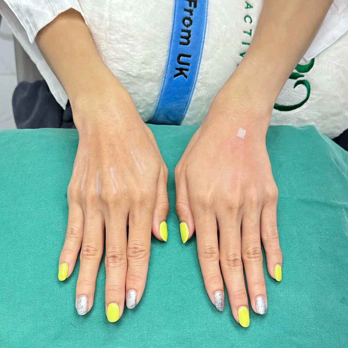 ฉีดฟิลเลอร์มือ