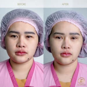 ศัลยกรรมตาสองชั้น