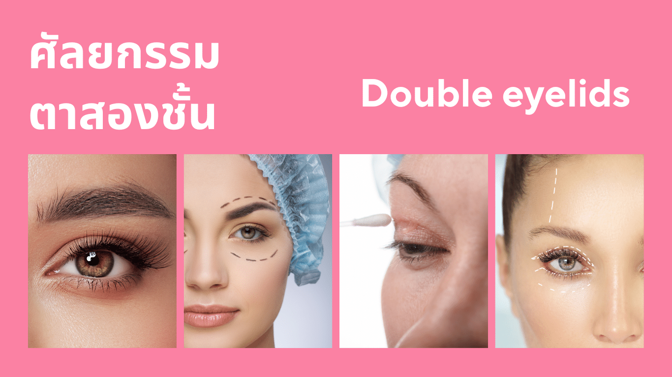 ศัลยกรรมตาสองชั้น