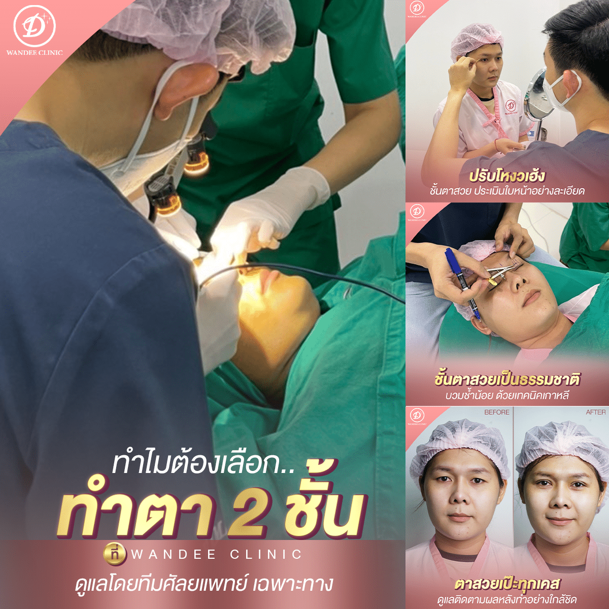 ศัลยกรรมตาสองชั้น