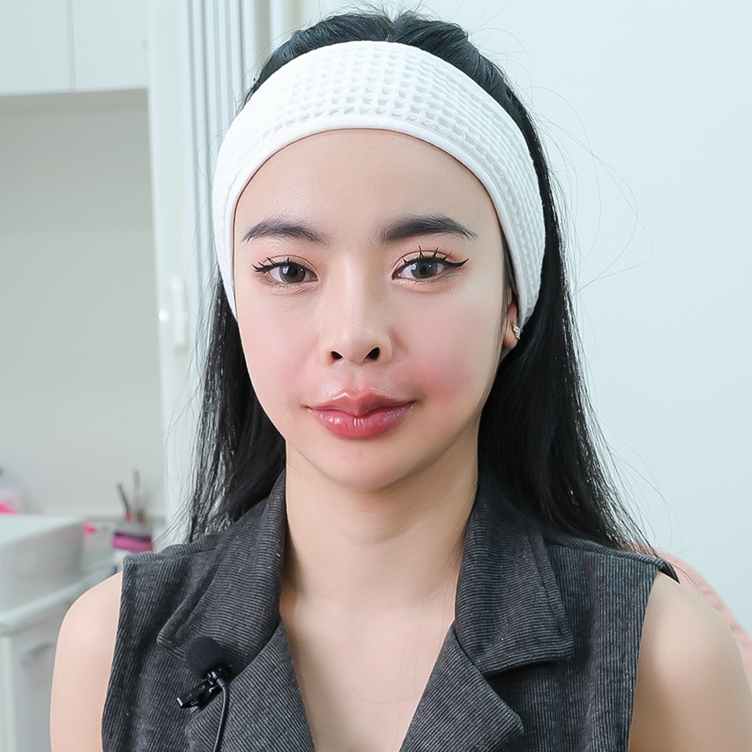 ฟิลเลอร์ปาก