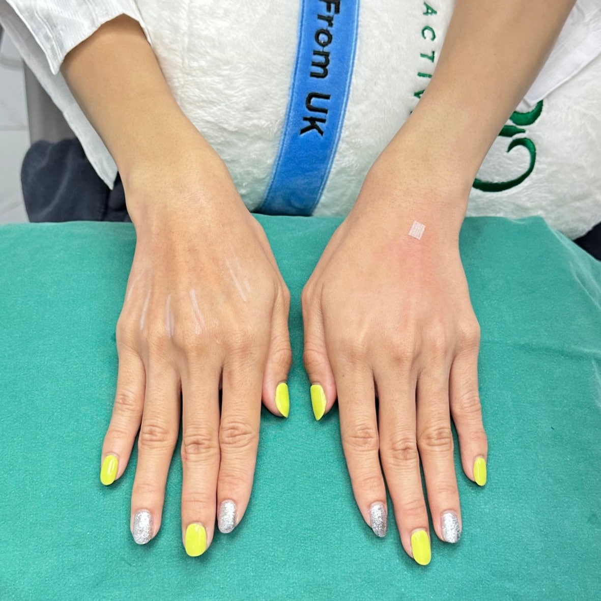 เติมฟิลเลอร์มือ