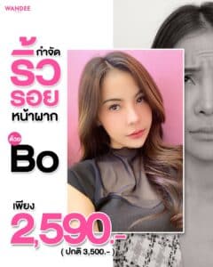 𝗕𝗢 ลดริ้วรอย