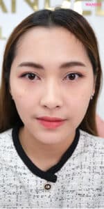 เติมร่องใต้ตา