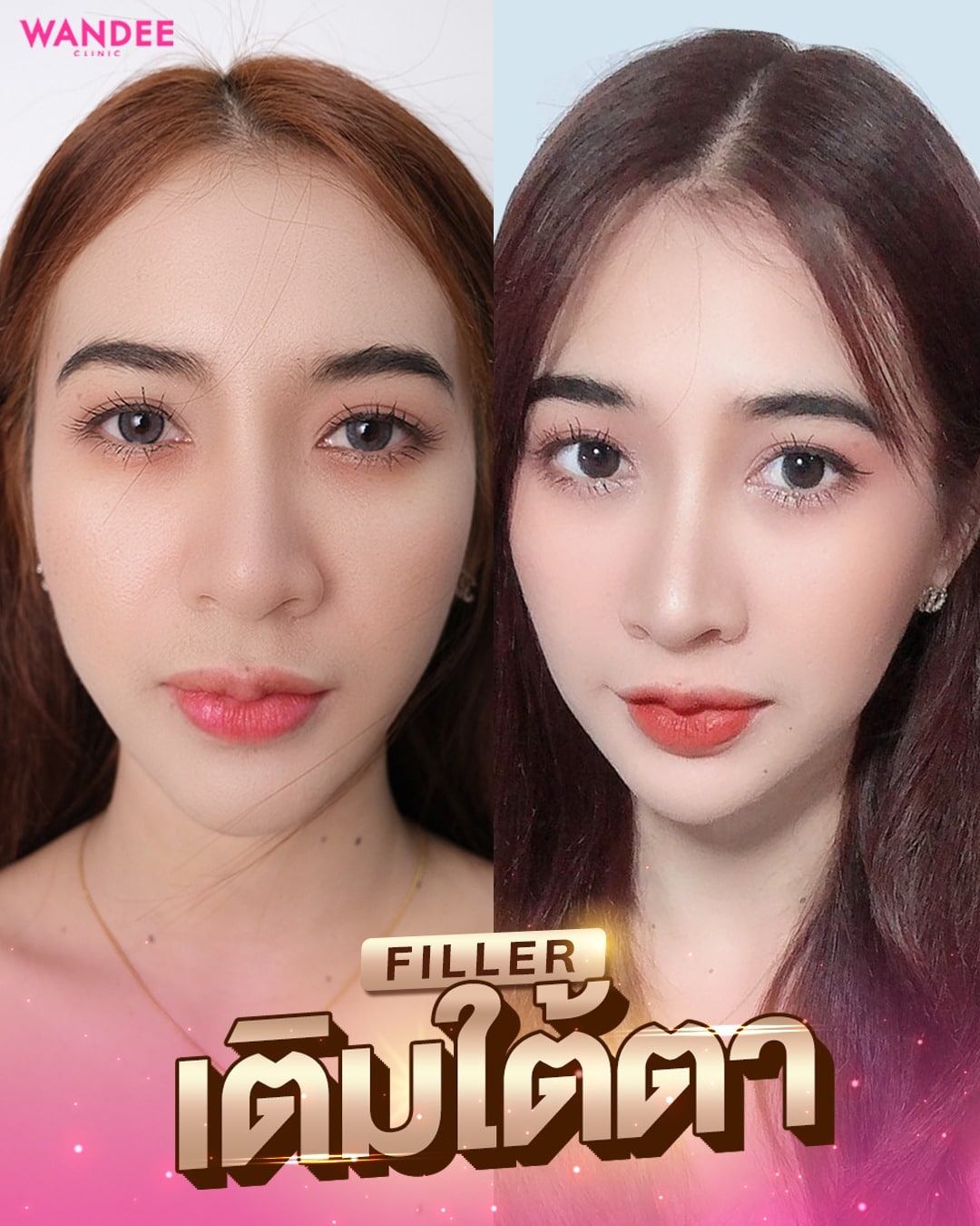 เติมใต้ตา