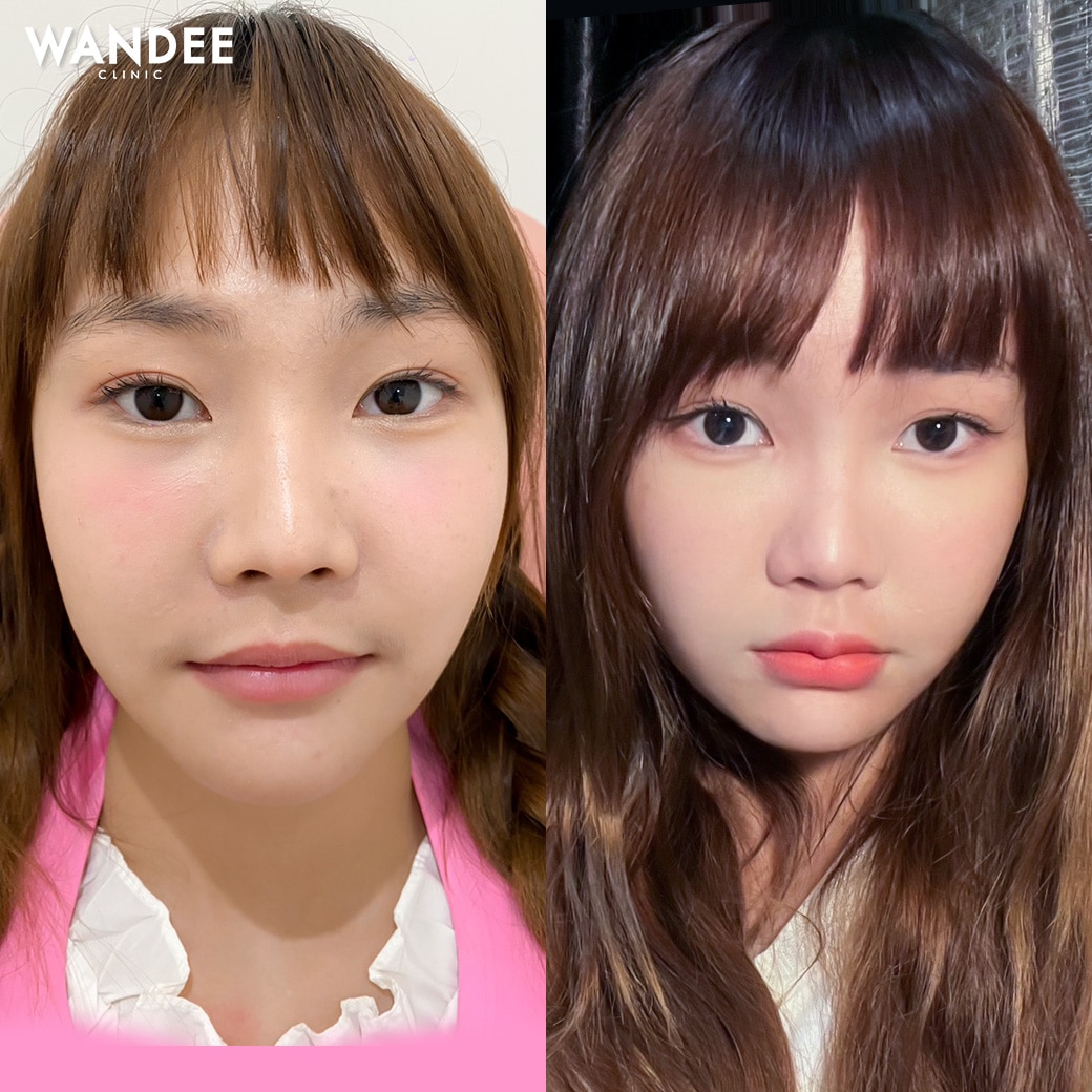 หมดปัญหาปากบางไม่ได้รูป