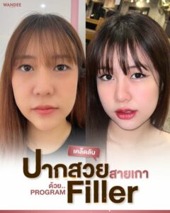 เติมปาก เพิ่มวอลลุ่ม