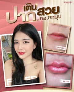 เติมฟิลเลอร์ปากบาง