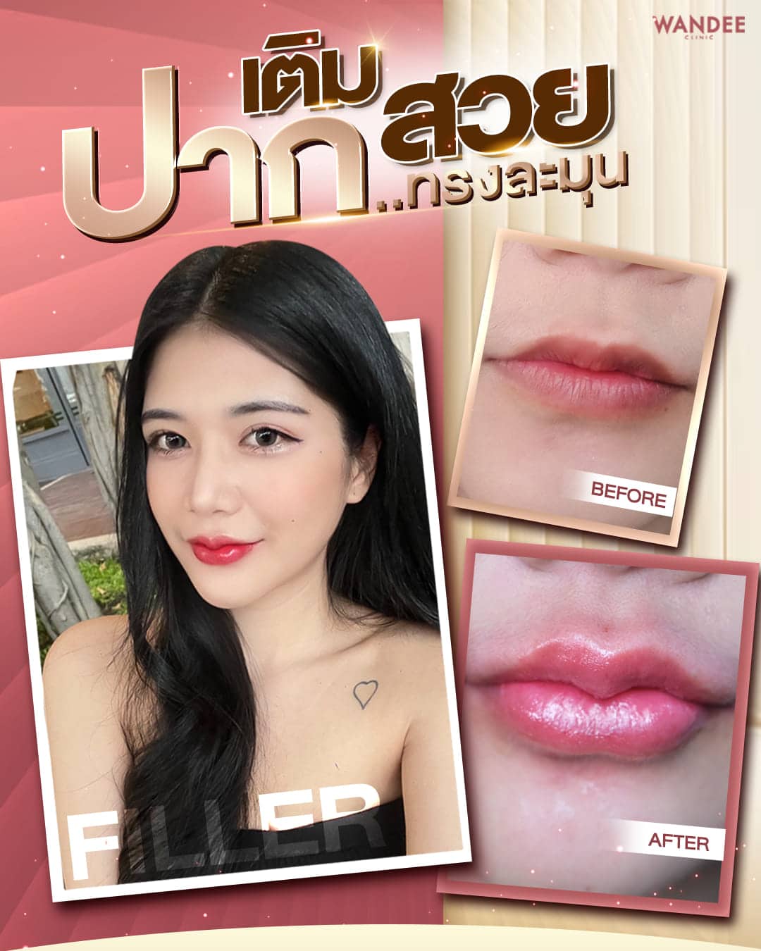 เติมฟิลเลอร์ปากบาง