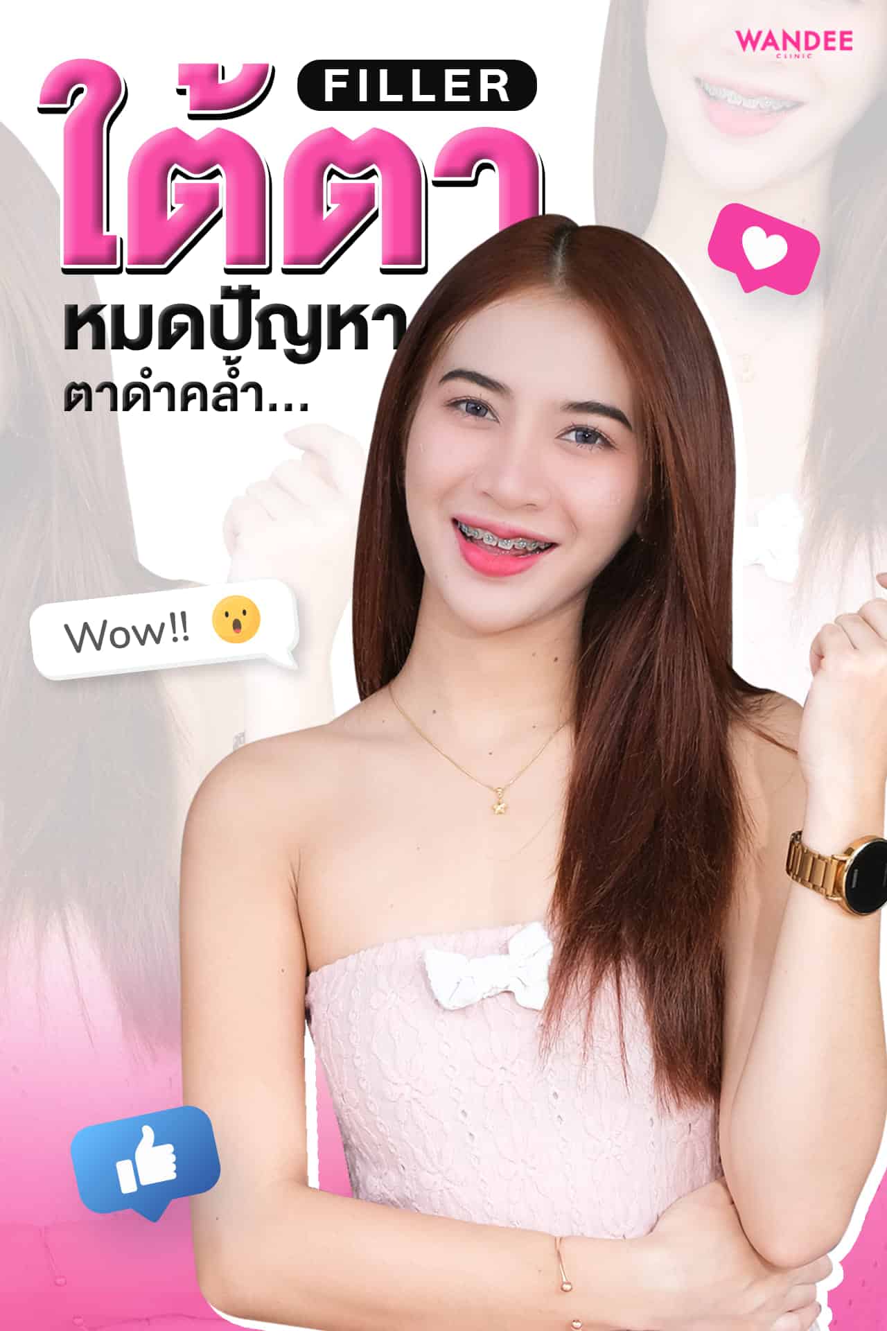 ฟิลเลอร์ใต้ตา