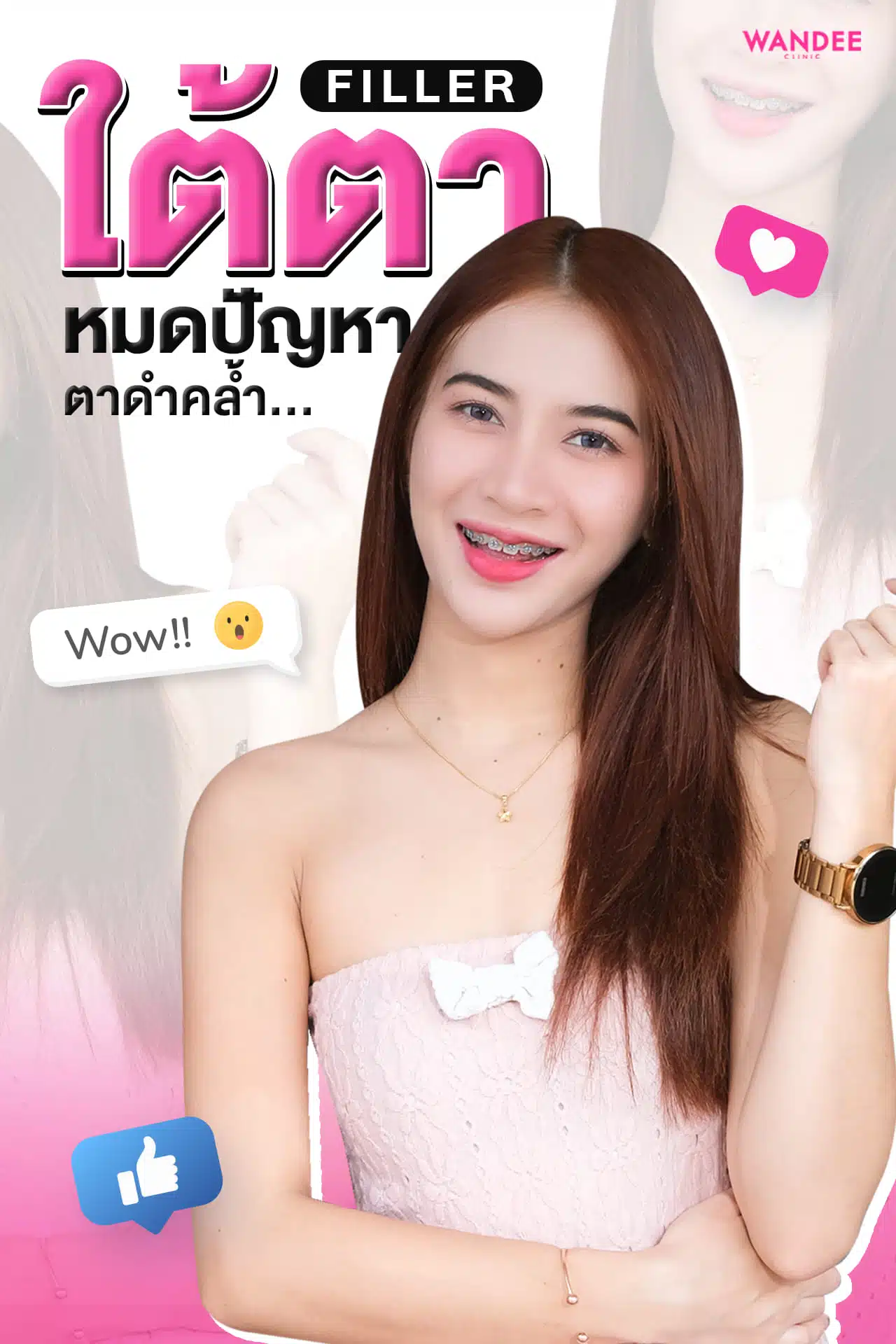 ฟิลเลอร์ใต้ตา