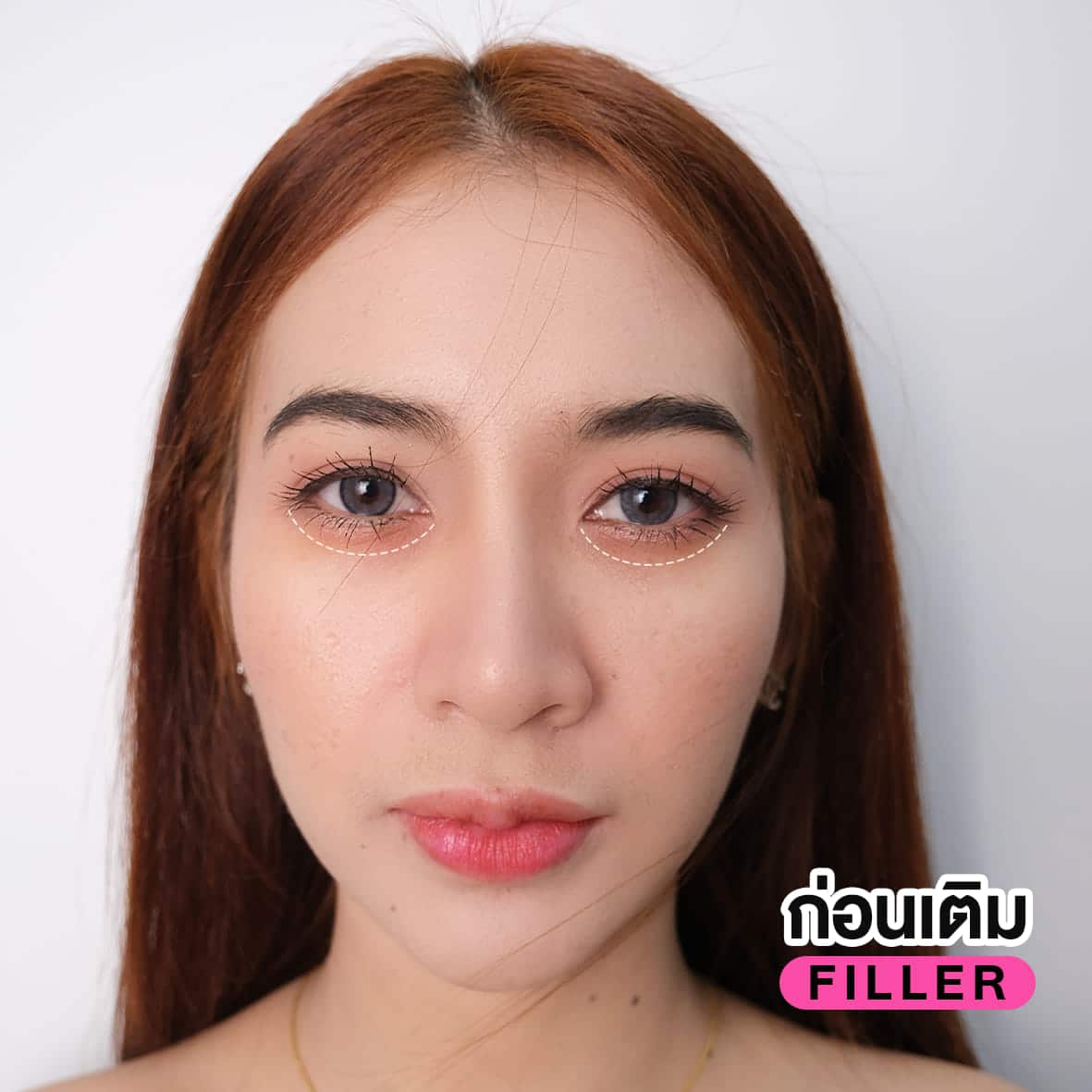 ฟิลเลอร์ใต้ตา