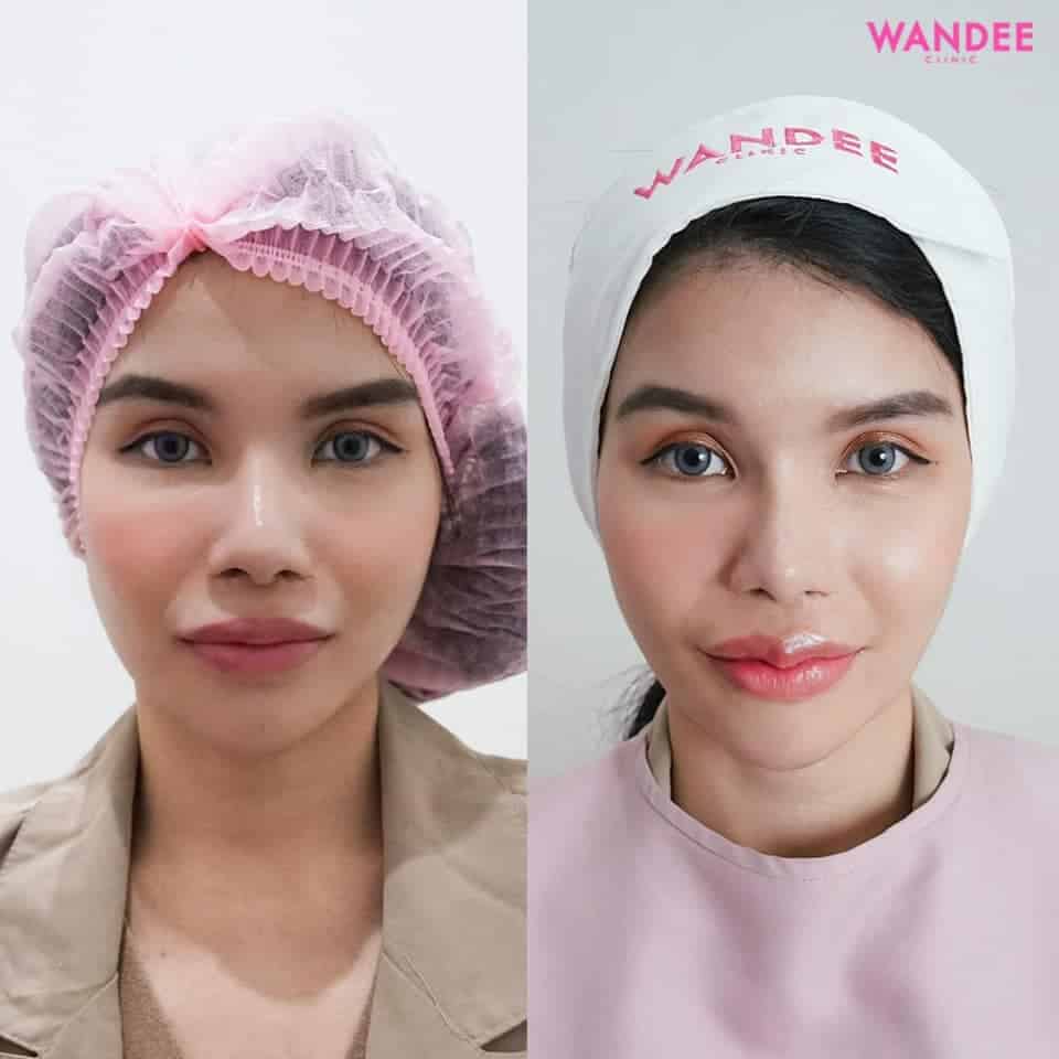 𝗙𝗶𝗹𝗹𝗲𝗿 สุดฮิตตลอดปี