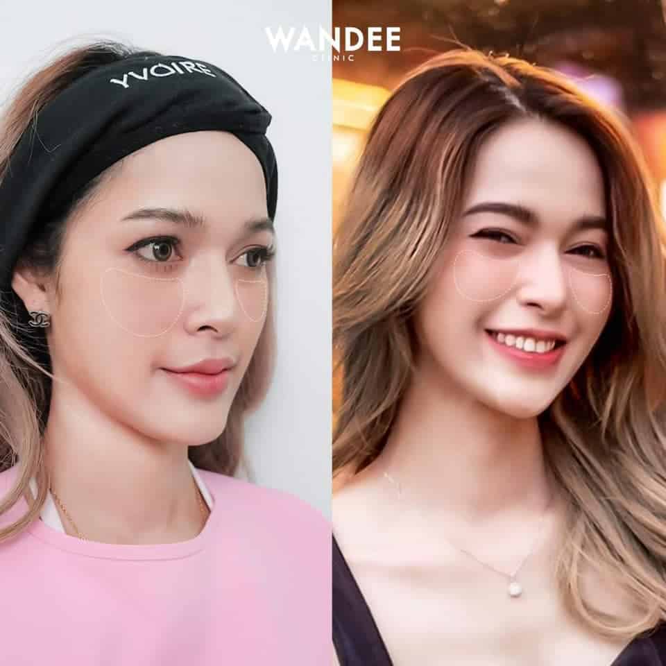 𝗙𝗶𝗹𝗹𝗲𝗿 สุดฮิตตลอดปี