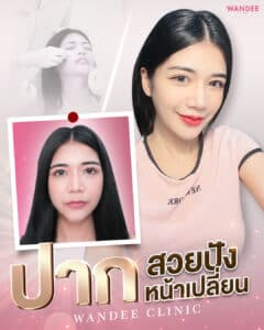 เติมปากกระจับทรงชัด