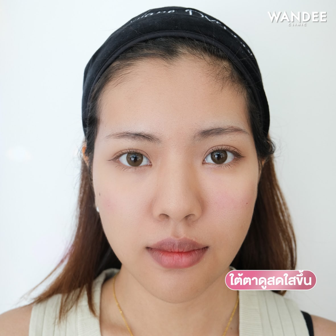 𝗣𝗿𝗼𝗴𝗿𝗮𝗺 𝗙𝗶𝗹𝗹𝗲𝗿 ใต้ตา