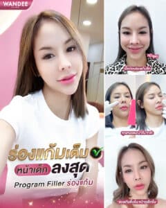 𝗣𝗿𝗼𝗴𝗿𝗮𝗺 𝗙𝗶𝗹𝗹𝗲𝗿 เติมเต็มร่องแก้ม