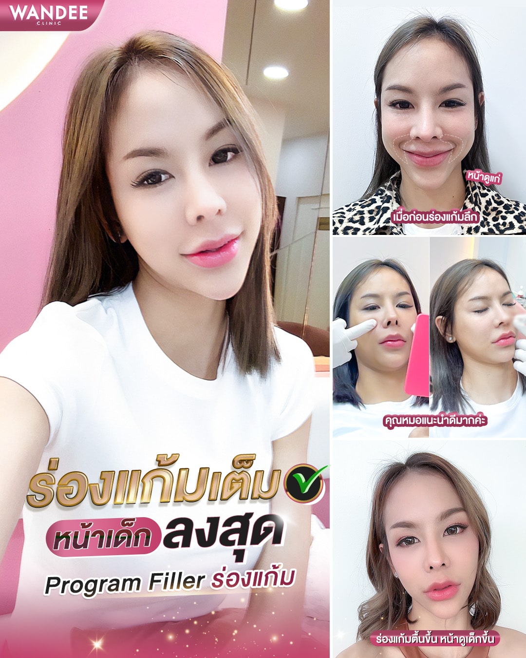 𝗣𝗿𝗼𝗴𝗿𝗮𝗺 𝗙𝗶𝗹𝗹𝗲𝗿 เติมเต็มร่องแก้ม