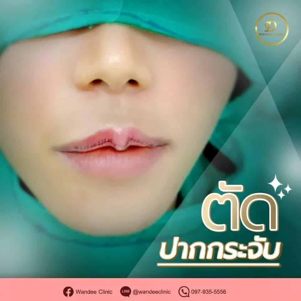 ศัลยกรรมปากปรับรูปปาก