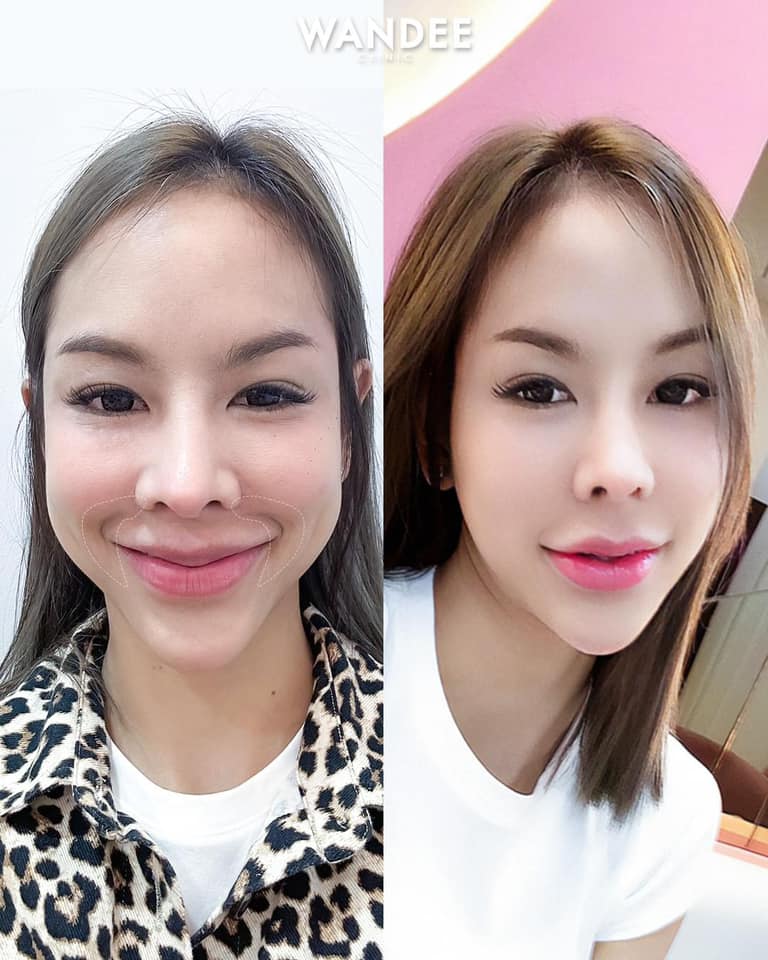 𝗣𝗿𝗼𝗴𝗿𝗮𝗺 𝗙𝗶𝗹𝗹𝗲𝗿 ทุกจุด