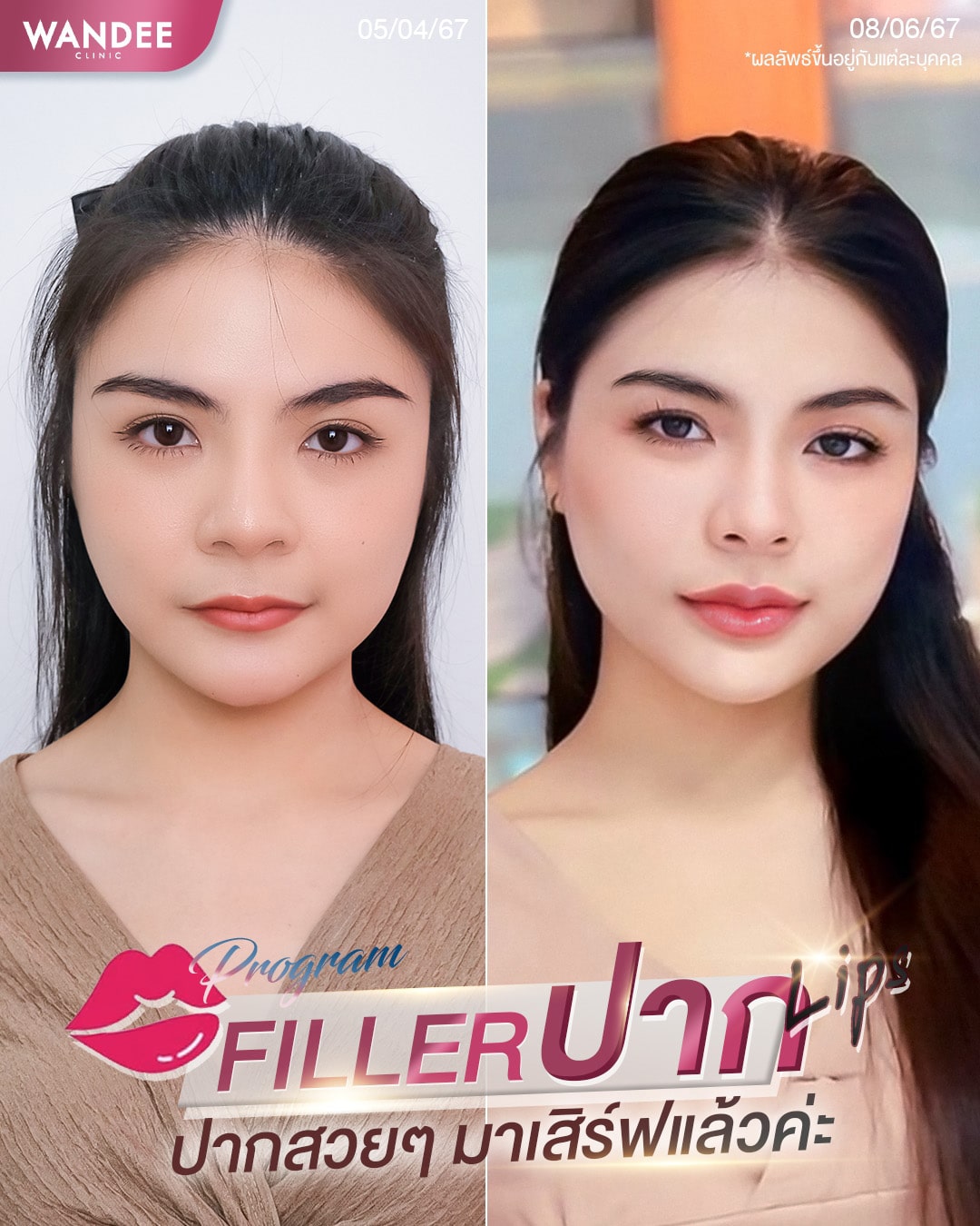 𝗣𝗿𝗼𝗴𝗿𝗮𝗺 𝗙𝗶𝗹𝗹𝗲𝗿 ปากสวยๆ