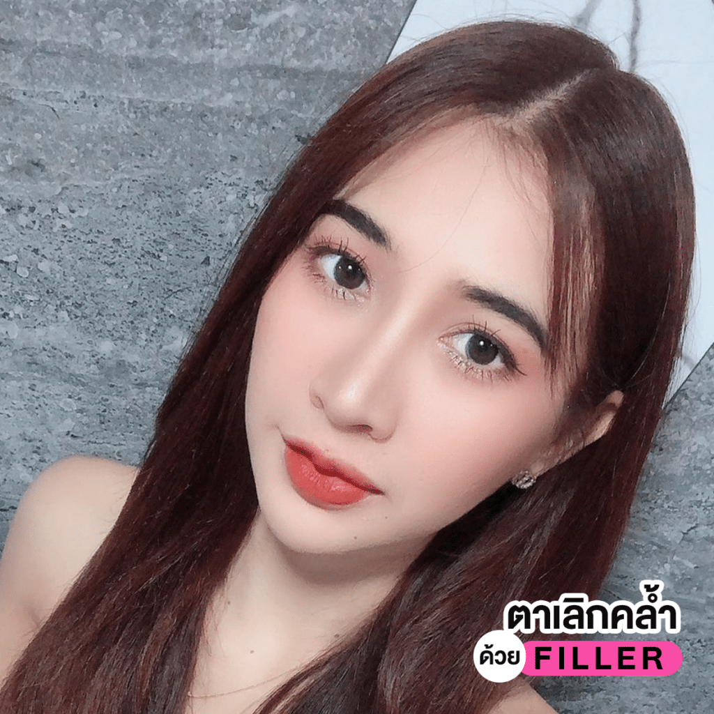 รีวิวฟิลเลอร์ใต้ตาคุณภัส