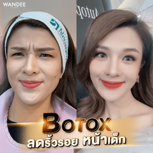 รีวิวโบท็อกซ์