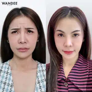 รีวิวโบท็อกซ์